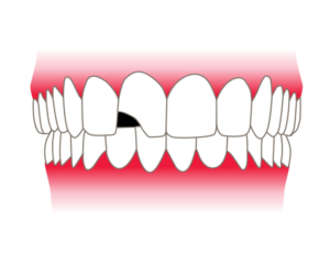 치아손상 이미지