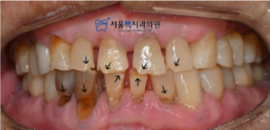 임플란트 치료 준비
