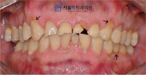 치료 전 앞니깨짐 이미지
