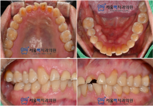 치료 전 앞니깨짐과 치아 마모 이미지