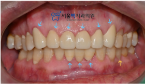 보철치료 완료 후 이미지
