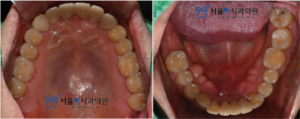 보철치료 후 구강 안쪽 이미지