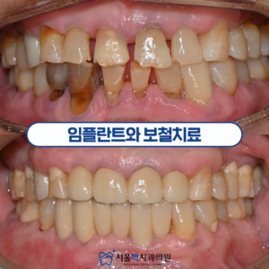 서울맥치과 임플란트
