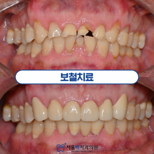 보철치료 타이틀 이미지