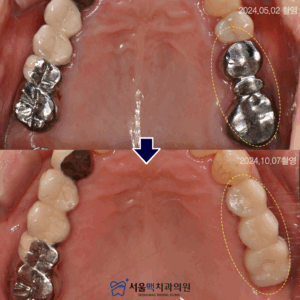 가양역임플란트 치료 전, 후 비교 이미지