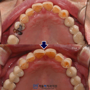 가양역치과 임플란트 식립 전