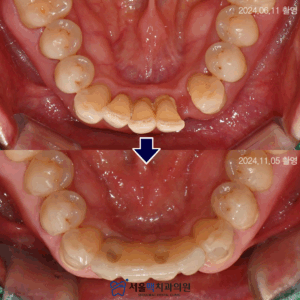 가양동치과 임플란트 전/후 사진