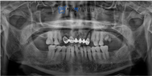가양역임플란트 치료 전 이미지