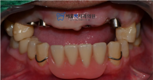 가양역임플란트 임시틀니 착용 이미지