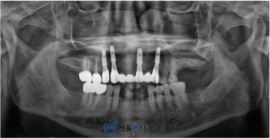 가양역임플란트 치료 후 X-ray 이미지