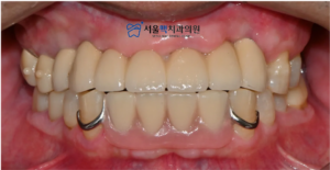 가양역임플란트 치료 완료 이미지