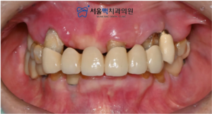 등촌동임플란트 치료 전 사진