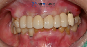 등촌동임플란트 치료 후 이미지