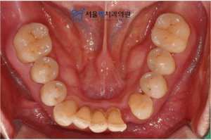 임플란트 전 구강 안쪽 이미지