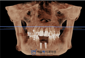 장비로 찍은 치료 전 이미지