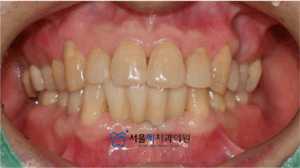 가양동치과 임플란트 식립 후 이미지