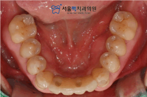 가양동치과 임플란트 치료 후 이미지