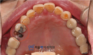 치료 전 구강상태 이미지