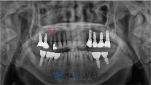 치료 전 장비로 구강상태 촬영 이미지
