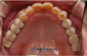 임플란트 식립 완료 이미지