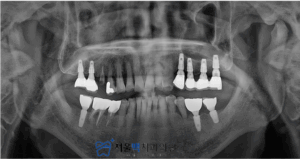 임플란트 식립 완료된 구강 촬영 이미지