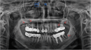 치료 계획 이미지