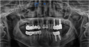 임플란트 후 촬영 이미지