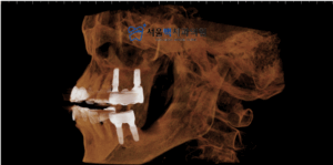 임플란트 후 촬영 이미지 옆모습