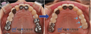 임플란트 전/ 후 비교 이미지
