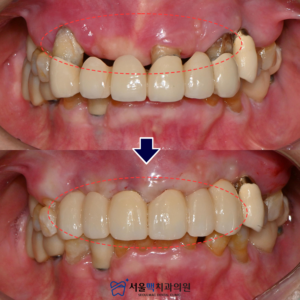 등촌동임플란트 치료 전/후 타이틀 이미지