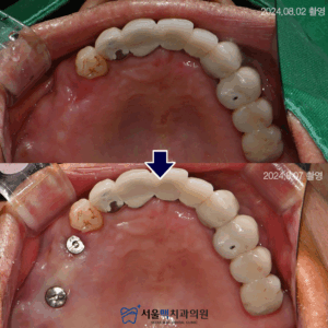 가양역임플란트