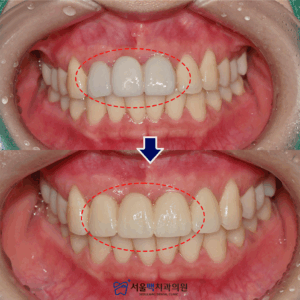 가양동치과 치료 사례