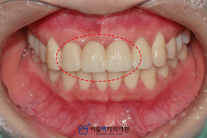 치료 완료된 이미지