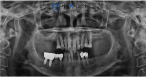 등촌동임플란트