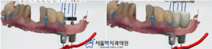 임플란트를 위한 모의 분석