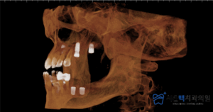 임플란트 식립 완료