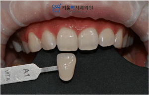 치아미백 후 사진
