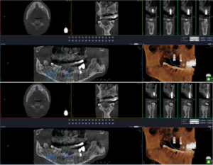 임플란트 식립 계획