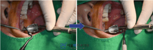 임플란트 식립 진행 중 이미지