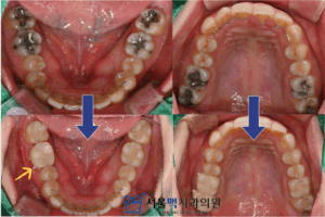 충치 치료 전, 후 비교