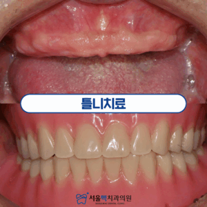 틀니치료 전후 타이틀