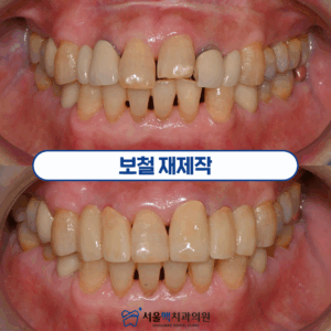 보철치료 타이틀