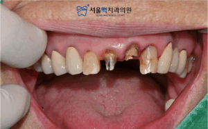 구강 상태 확인을 위한 초진 이미지