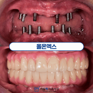 가양역치과 올온엑스 타이틀