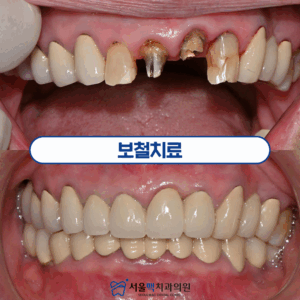 가양동치과 보철치료 타이틀