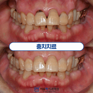 등촌동치과 치료 사례 타이틀